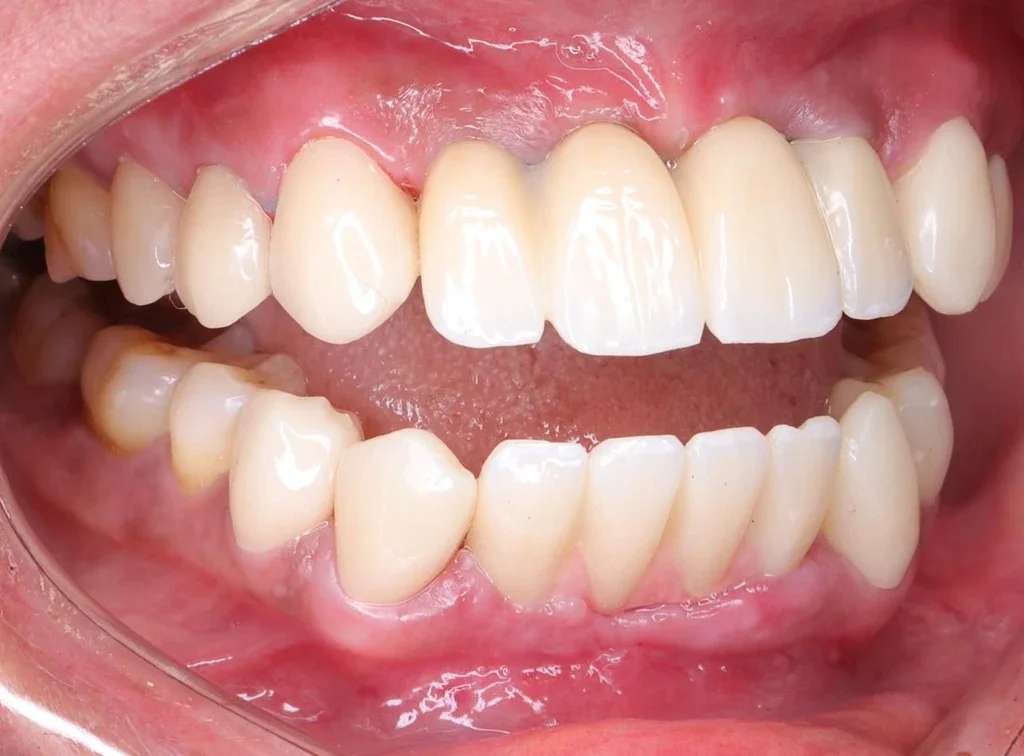 زراعة الاسنان — بعد