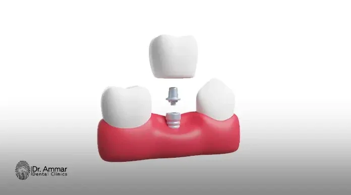 Dental root implantation