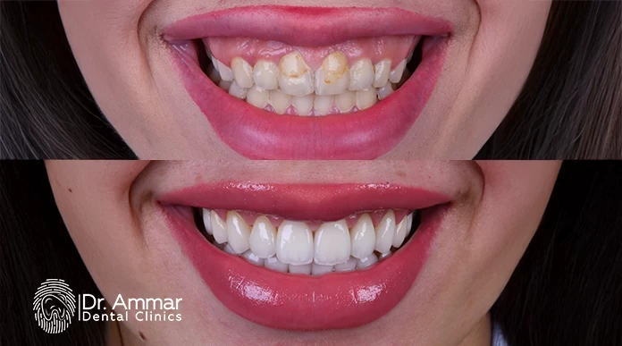 What is dental veneer image