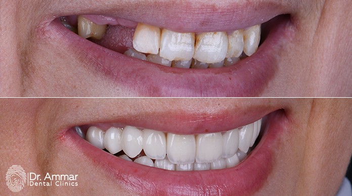 Tooth Implant image