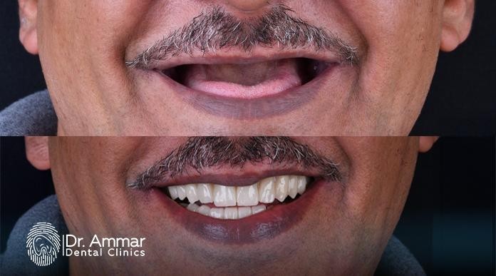 Dental Implants Before and After image