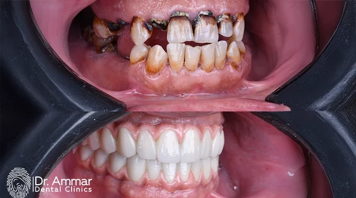 Laser dental implants in Riyadh image