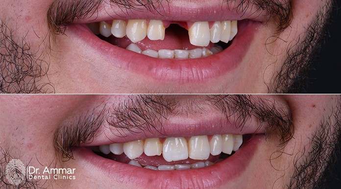 Front Teeth Implants image