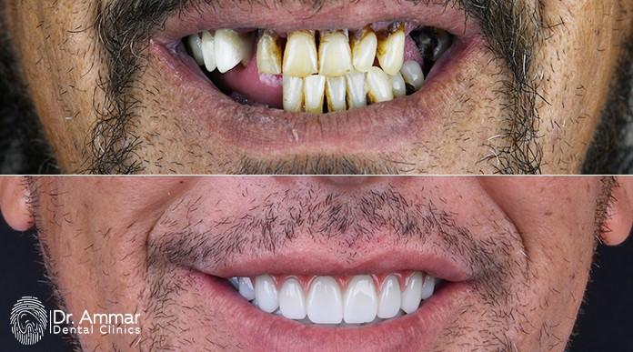 Dental Implant Cost in Riyadh image