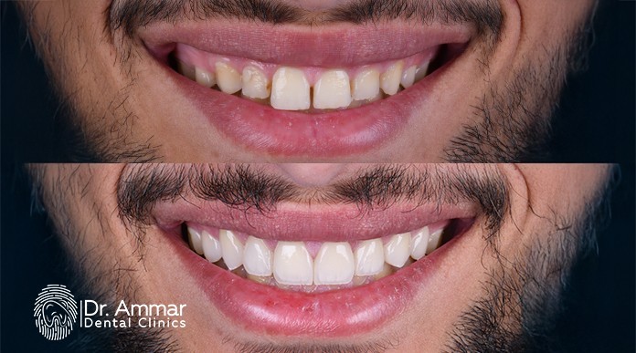 Prices of Removable Dental Veneers image