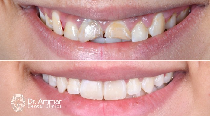 انواع تسوس الاسنان بالصور