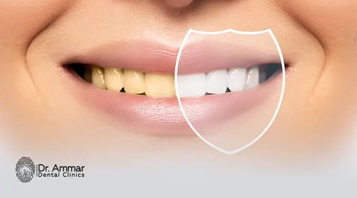 طرق تبيض الاسنان