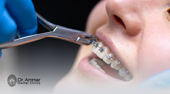 انواع تقويم الاسنان و اسعارها