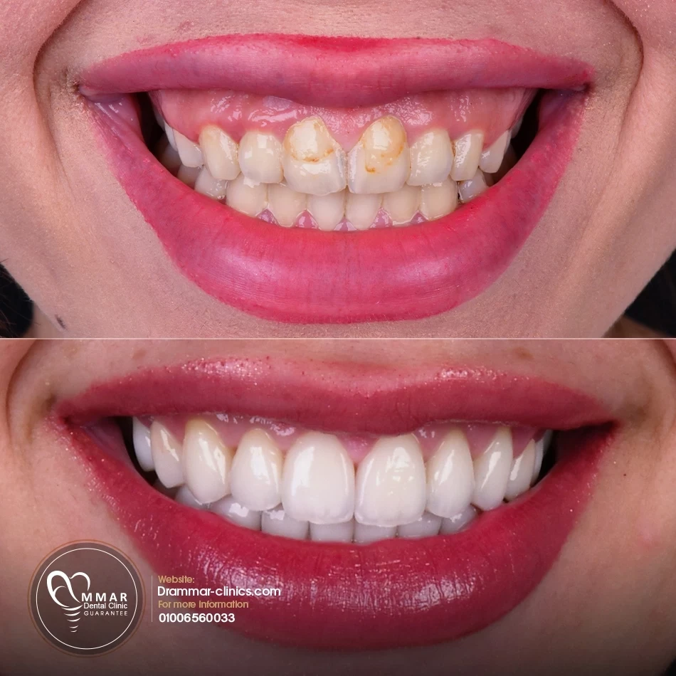 حالات فينير قبل وبعد