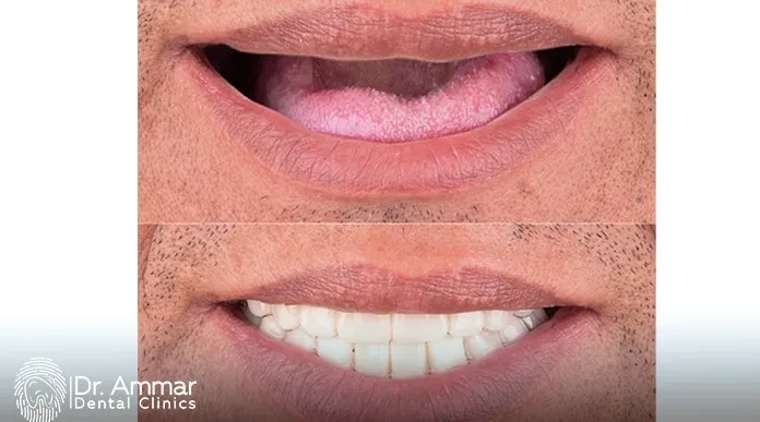 خطوات زراعة الاسنان