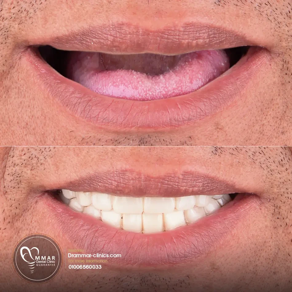 خطوات زراعة الفكين