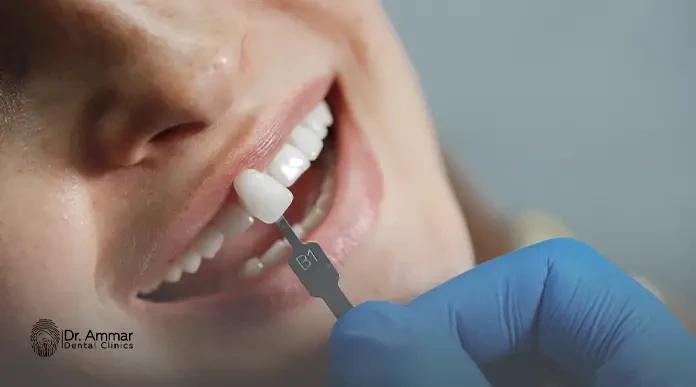 تركيب عدسات الاسنان بدون برد