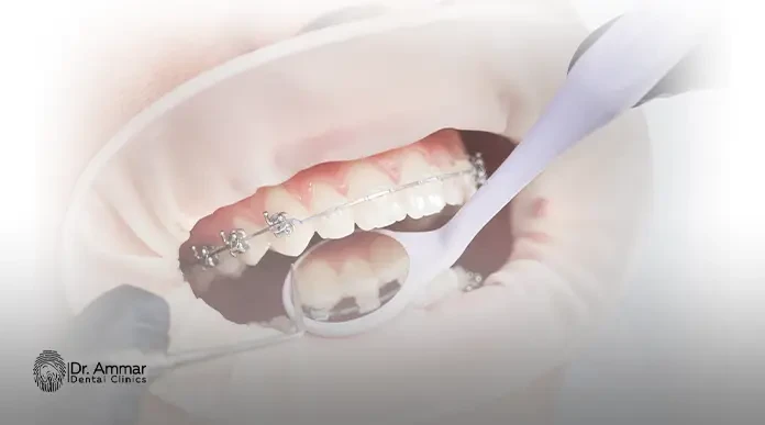 أسعار تركيبات ايماكس الماني