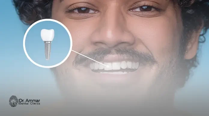 سعر تركيب ضرس مكان المخلوع