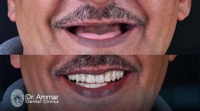 تعليمات بعد زراعة عظم الفك