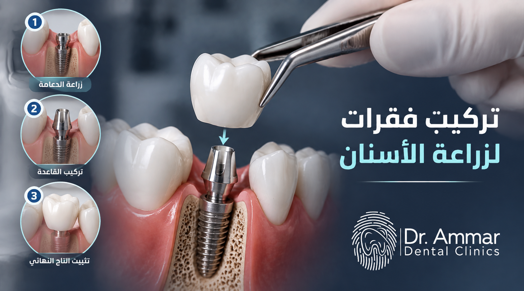 تركيب فقرات لزراعة الاسنان