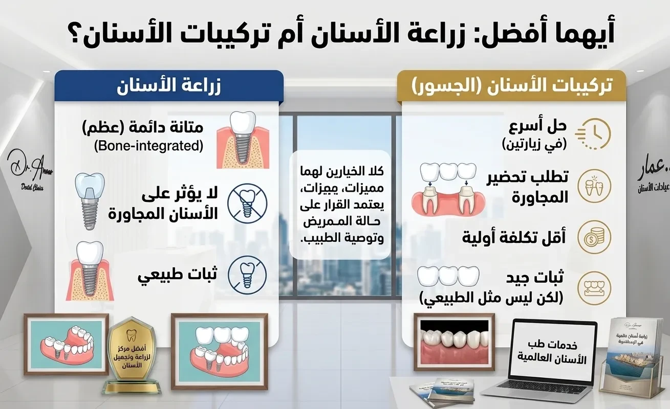 ايهما افضل زراعة الاسنان او التركيب