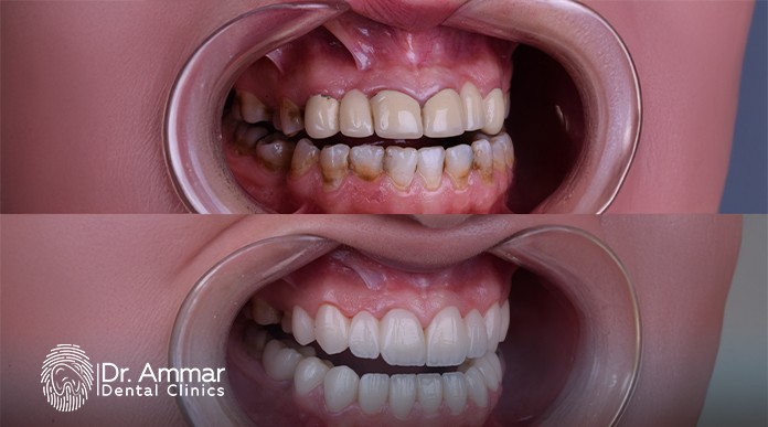 Causes of gingivitis image