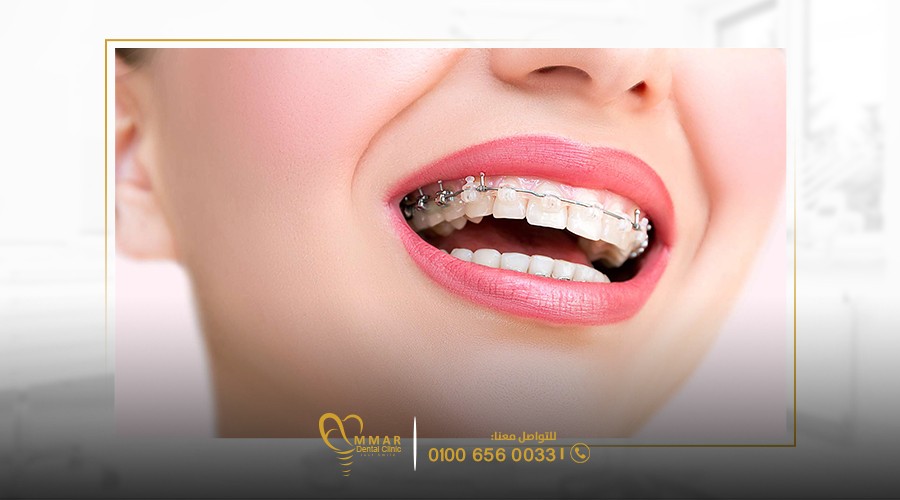 اضرار تقويم الأسنان: ما يجب أن تعرفه قبل البدء بالعلاج image