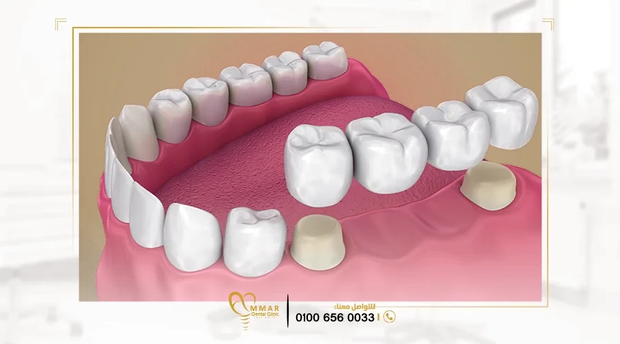 تركيب بريدج اسنان image