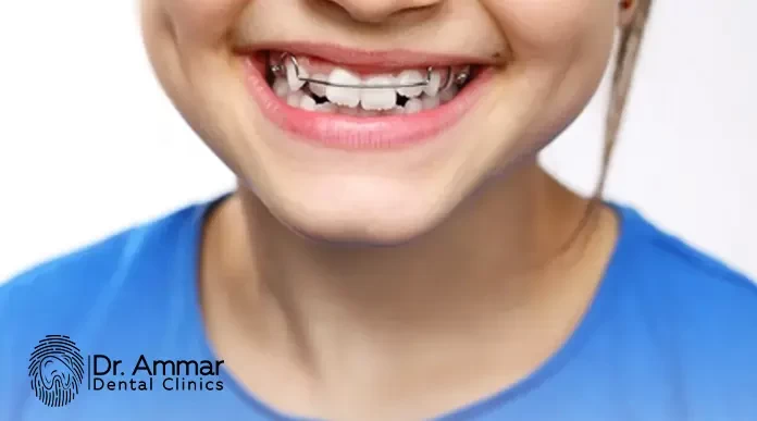 اشكال تقويم الاسنان image