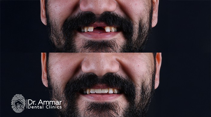 Instructions after tooth extraction image