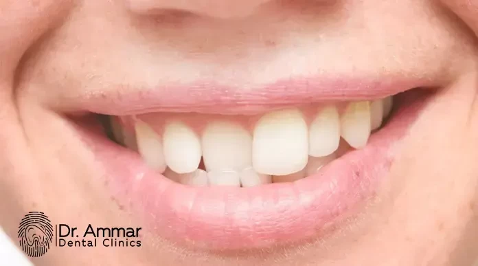 علاج الاسنان المعوجة بدون تقويم image