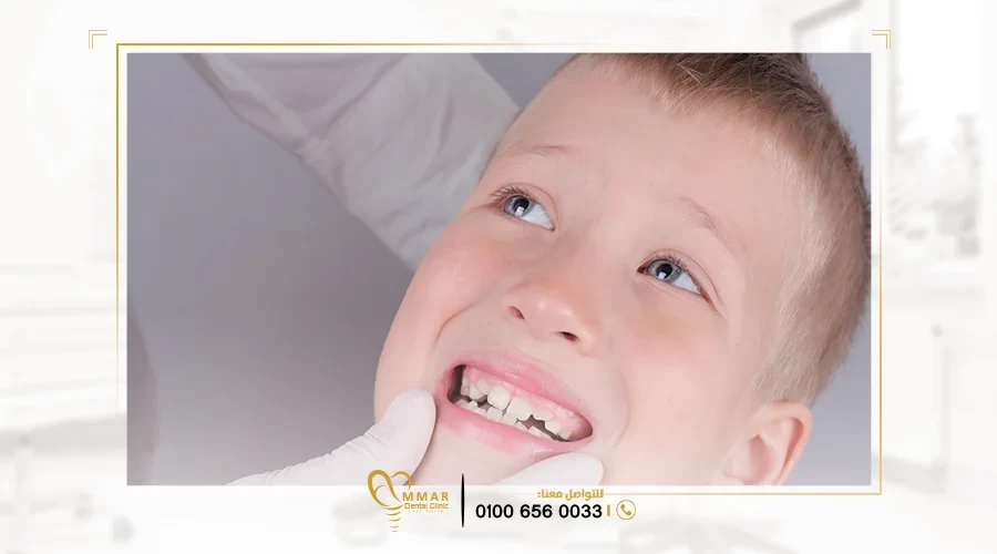 علاج الاسنان المعوجة بدون تقويم image