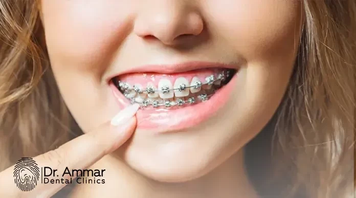 اسعار التقويم الاسنان فى مصر image