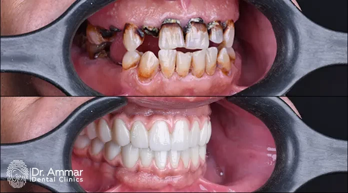 Immediate dental implants image