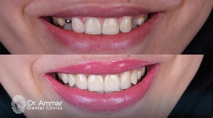 How long does dental implant pain last image