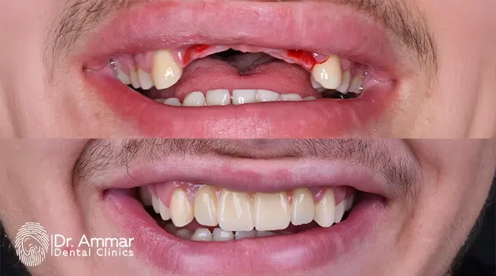 انواع زراعة الاسنان image