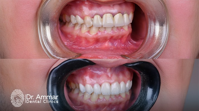 Fast-acting gingivitis treatment image