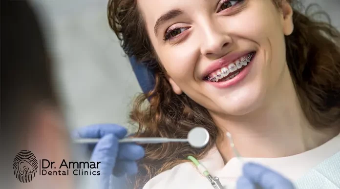 اضرار تقويم الأسنان: ما يجب أن تعرفه قبل البدء بالعلاج image