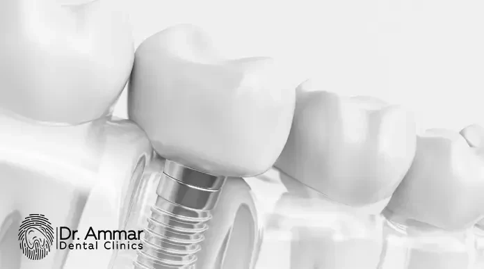 Impacted Wisdom Tooth Removal