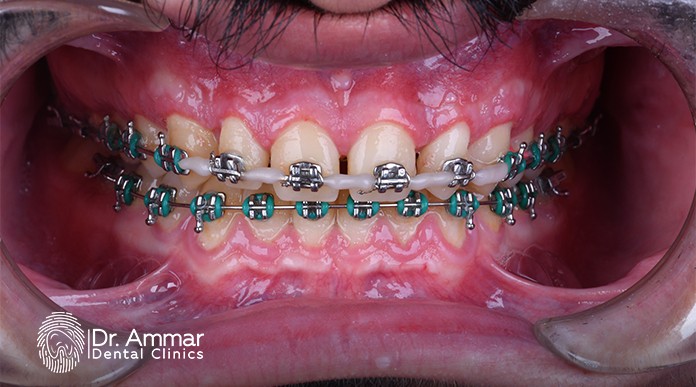 Popular Color Choices for Braces