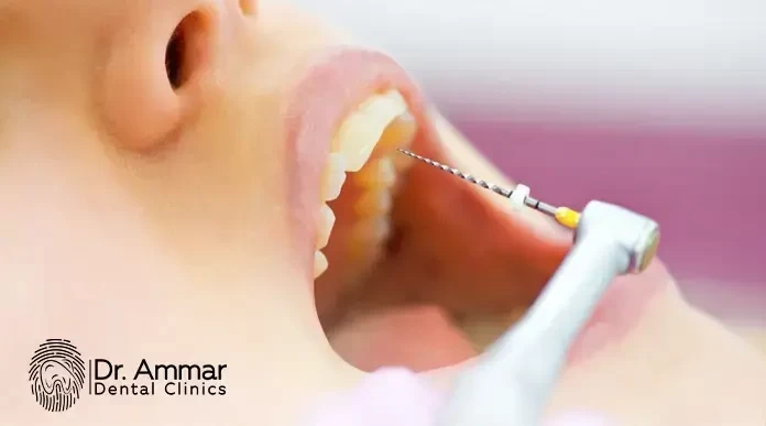 Front Tooth Root Canal