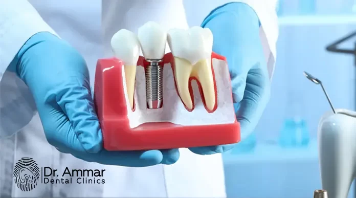 Disadvantages of Dental Implants