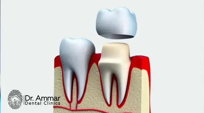 Types of dental crowns