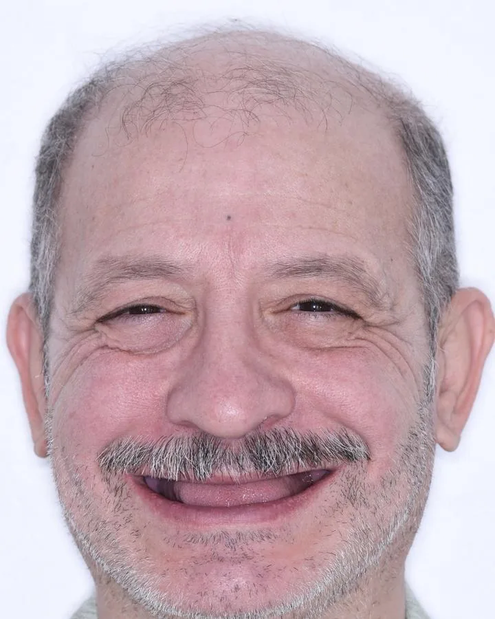 زراعة الاسنان — قبل
