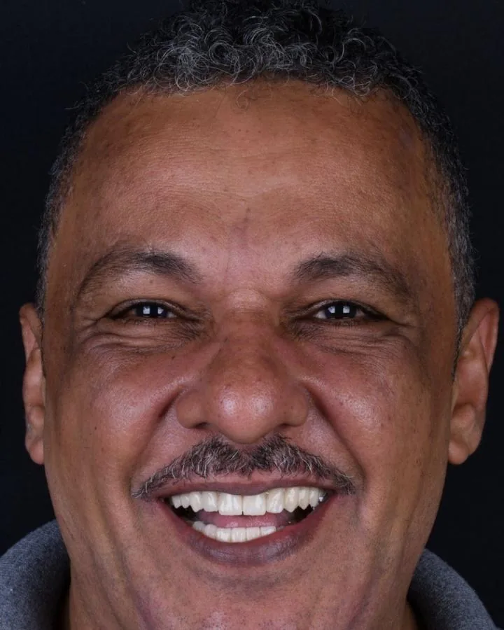 زراعة الاسنان — بعد