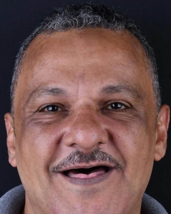 زراعة الاسنان — قبل