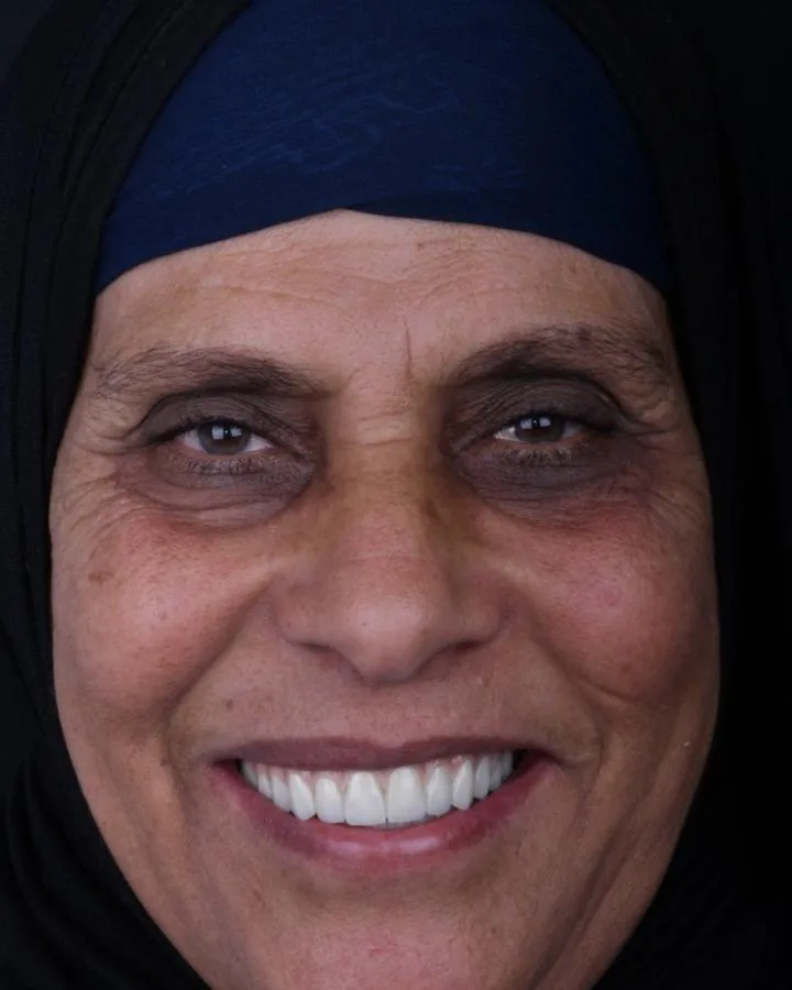 زراعة الاسنان — بعد