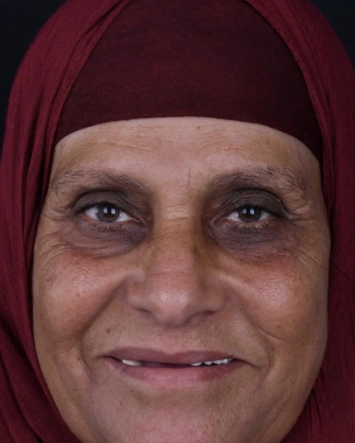 زراعة الاسنان — قبل