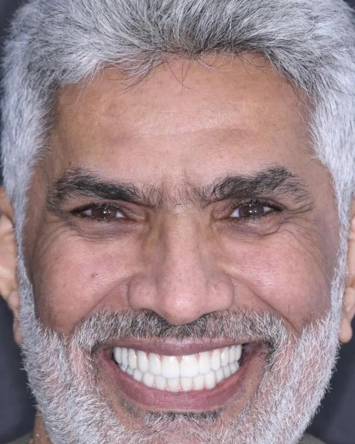 زراعة الاسنان — بعد