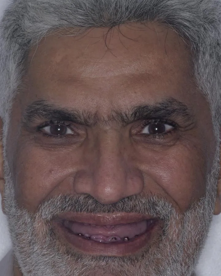زراعة الاسنان — قبل