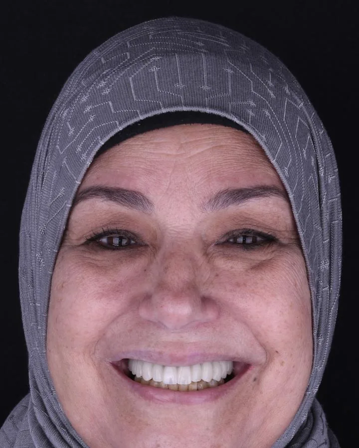 زراعة الاسنان — بعد
