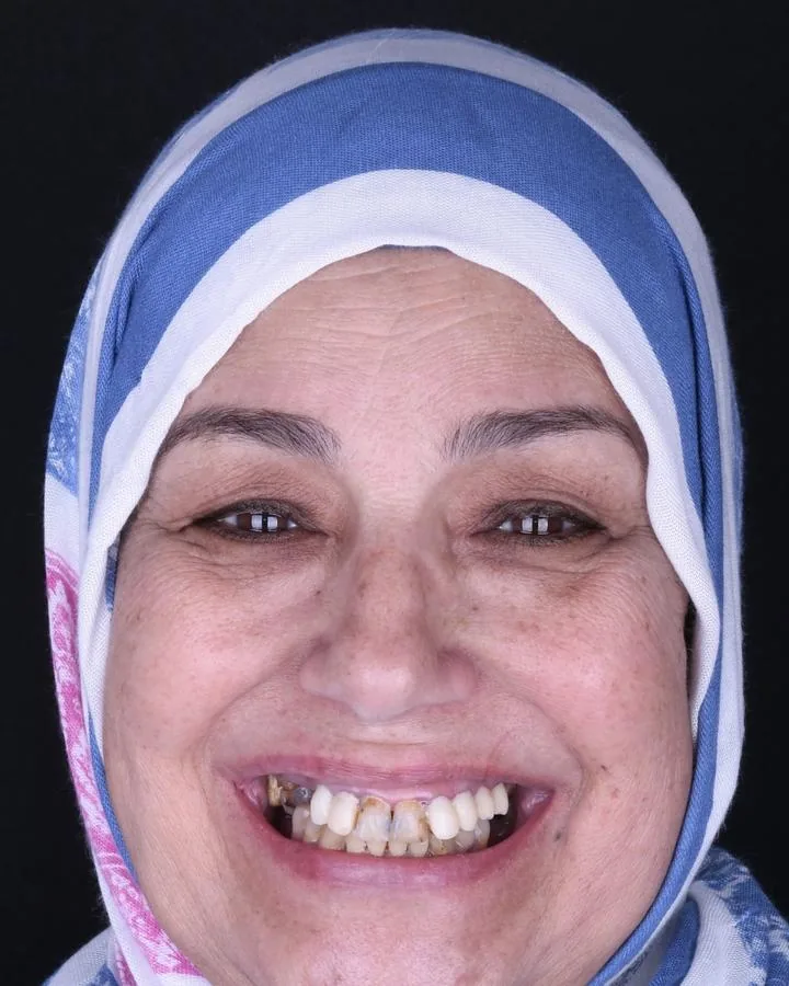 زراعة الاسنان — قبل