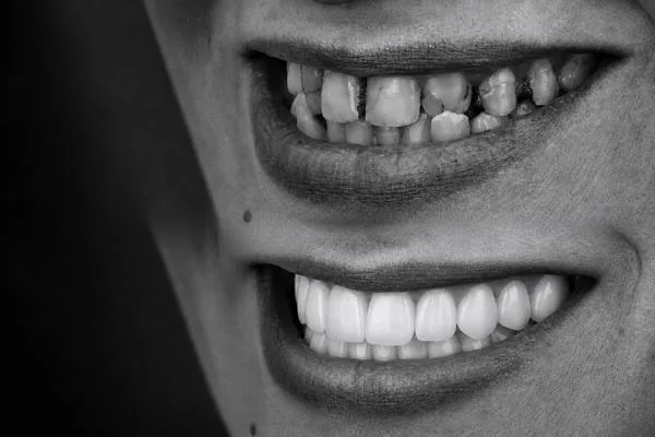 إعادة تأهيل الفكّين