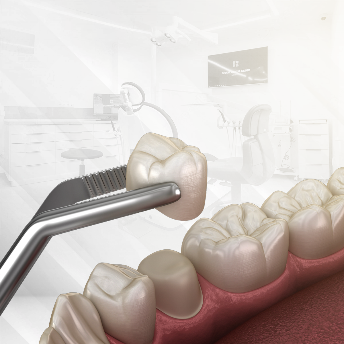 Post-root canal treatment image